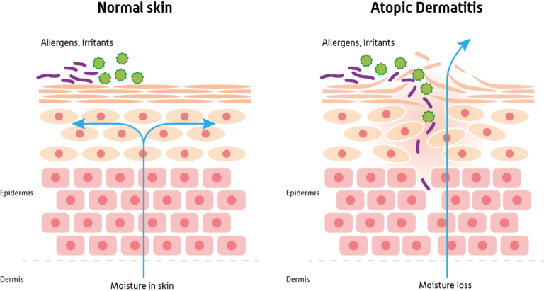 Skin barrier difference in normal skin versus skin with atopic dermatitis