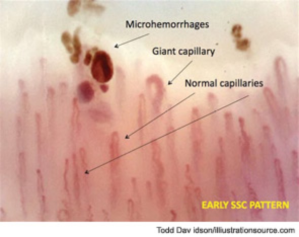 Nailfold capillary analysis showing giant capillaries and microhemorrhages in early systemic sclerosis